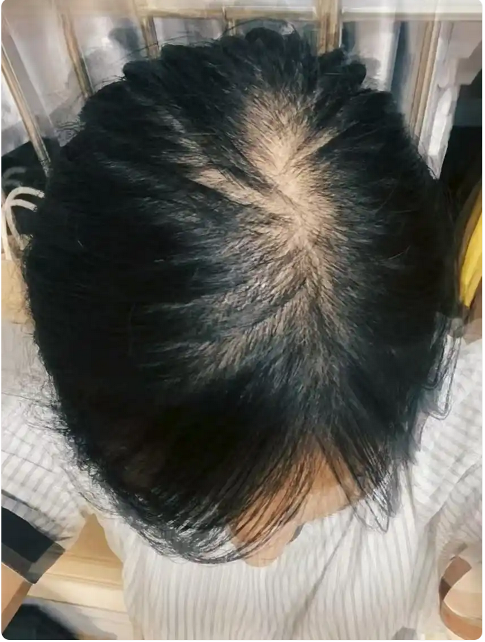 脱发人自救指南：从“掉发大户”到“碎发富翁”的逆袭